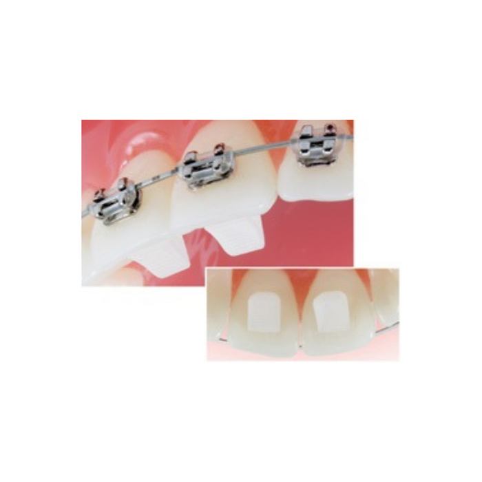 Composite Bite Ramp (10/pack)