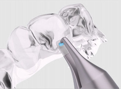 Clear Aligner Instruments — Smile Stream Solutions